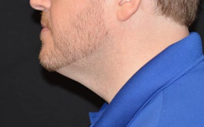 CoolSculpting Before & After Gallery - Patient 115342 - Image 2