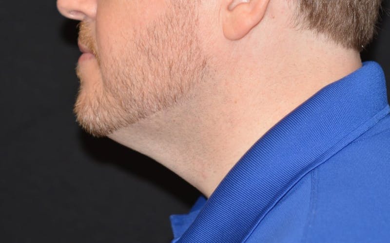 CoolSculpting Before & After Gallery - Patient 115342 - Image 2