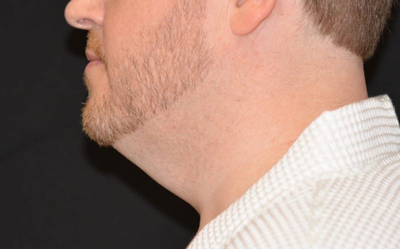 CoolSculpting Before & After Gallery - Patient 115342 - Image 1