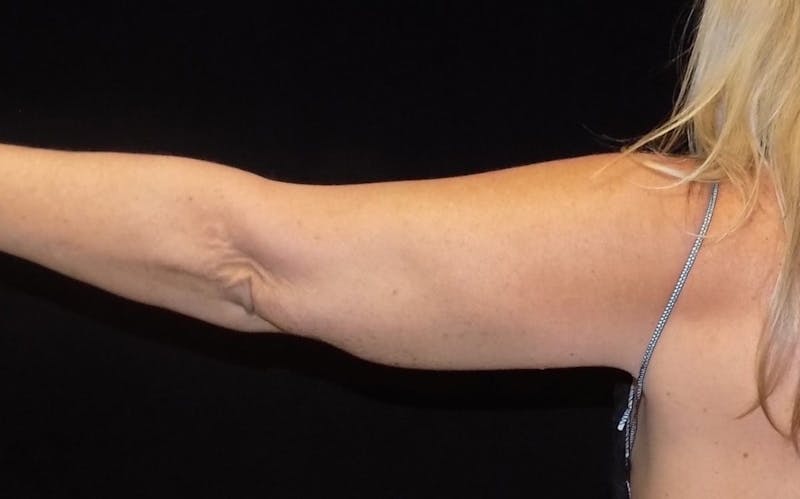 CoolSculpting Before & After Gallery - Patient 429330 - Image 2