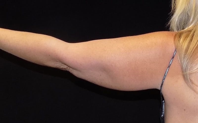 CoolSculpting Before & After Gallery - Patient 429330 - Image 1