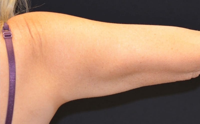 CoolSculpting Before & After Gallery - Patient 315723 - Image 2