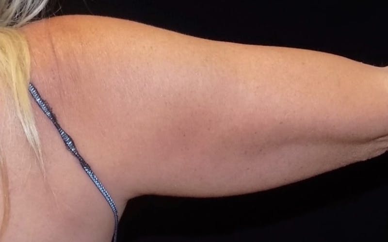 CoolSculpting Before & After Gallery - Patient 315723 - Image 1