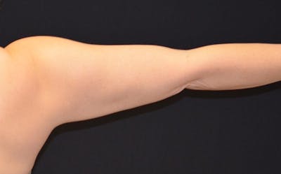 CoolSculpting Before & After Gallery - Patient 341137 - Image 2