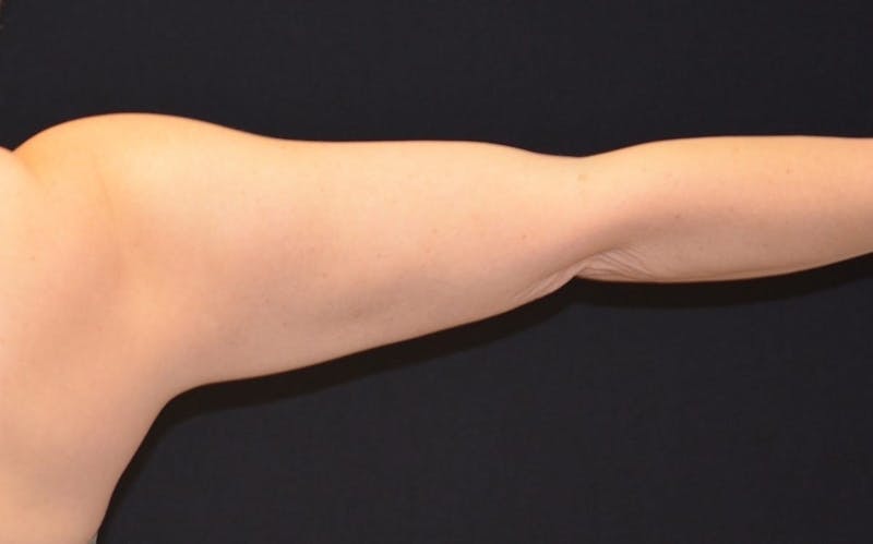 CoolSculpting Before & After Gallery - Patient 341137 - Image 2