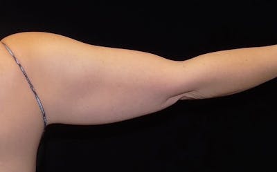 CoolSculpting Before & After Gallery - Patient 341137 - Image 1