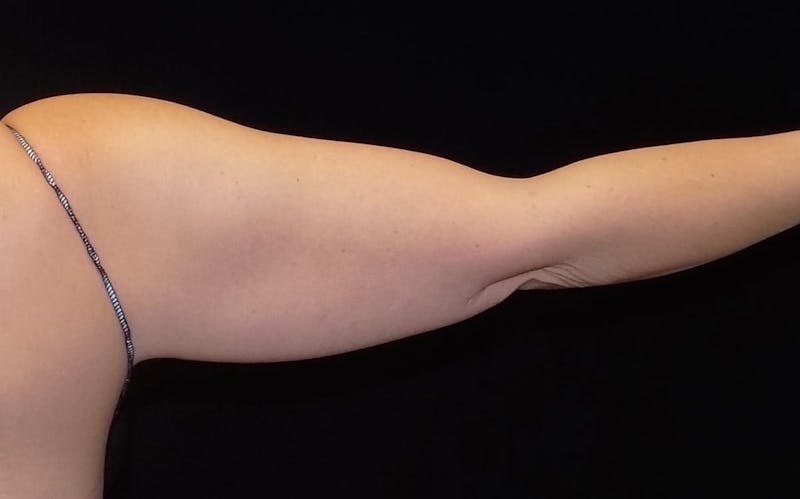 CoolSculpting Before & After Gallery - Patient 341137 - Image 1