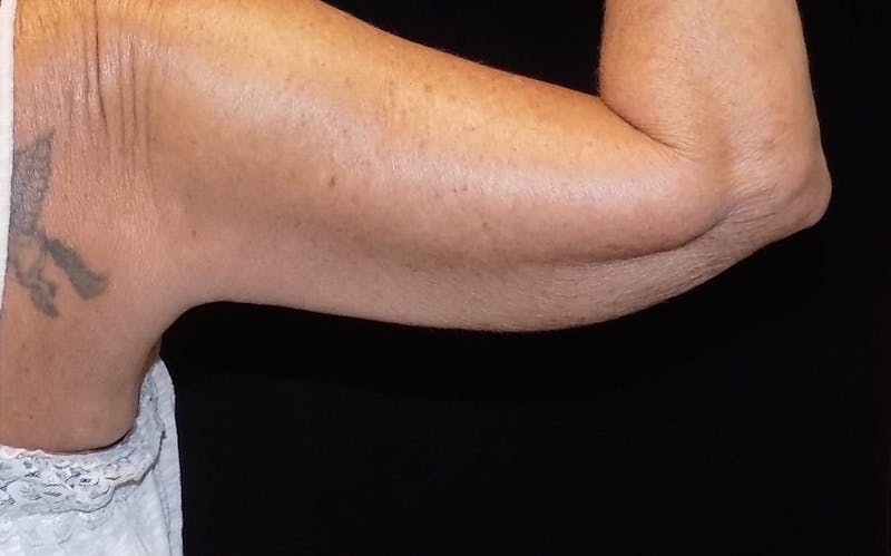 CoolSculpting Before & After Gallery - Patient 149549 - Image 2