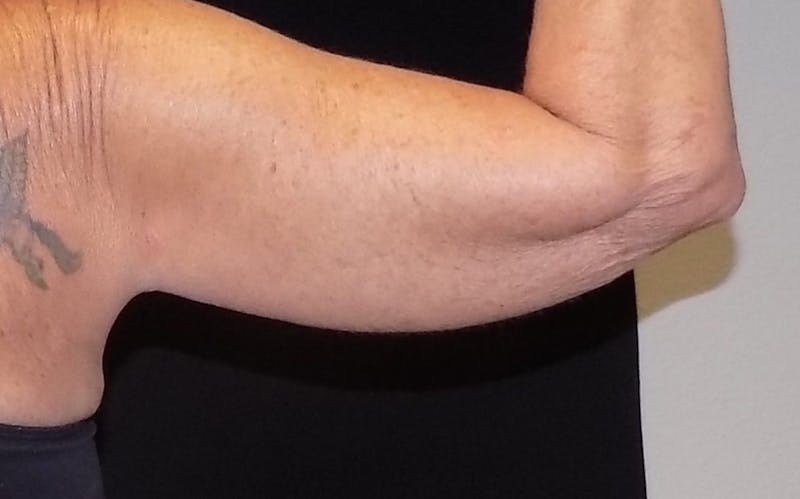 CoolSculpting Before & After Gallery - Patient 149549 - Image 1