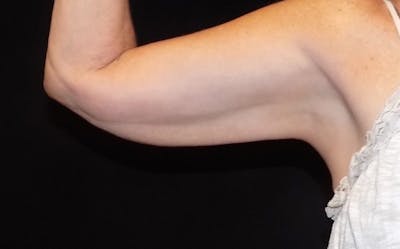 CoolSculpting Before & After Gallery - Patient 420062 - Image 2