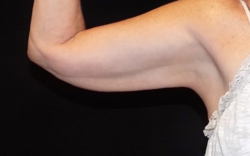 CoolSculpting Before & After Gallery - Patient 420062 - Image 2