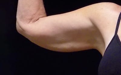 CoolSculpting Before & After Gallery - Patient 420062 - Image 1
