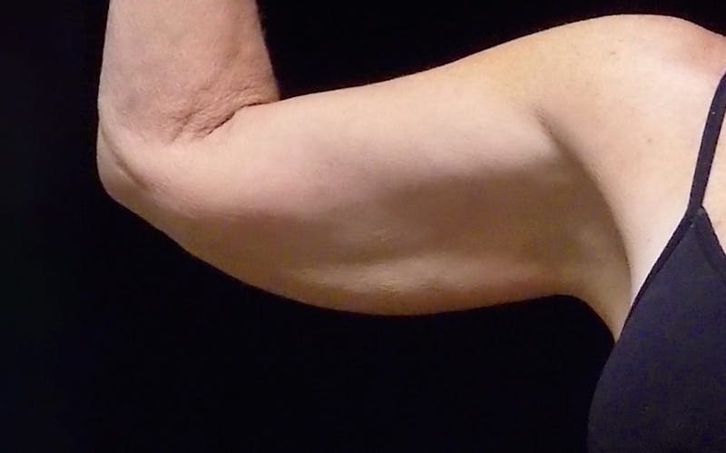 CoolSculpting Before & After Gallery - Patient 420062 - Image 1