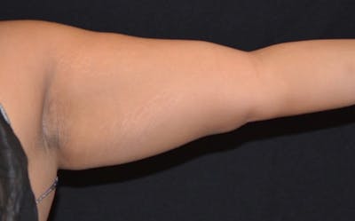 CoolSculpting Before & After Gallery - Patient 366853 - Image 2