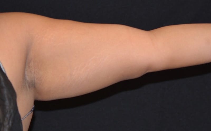 CoolSculpting Before & After Gallery - Patient 366853 - Image 2