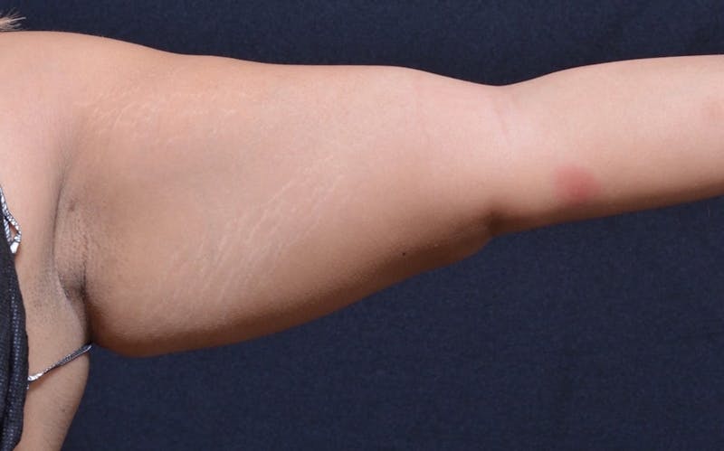 CoolSculpting Before & After Gallery - Patient 366853 - Image 1