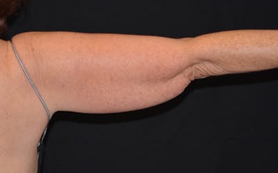 CoolSculpting Before & After Gallery - Patient 416257 - Image 2
