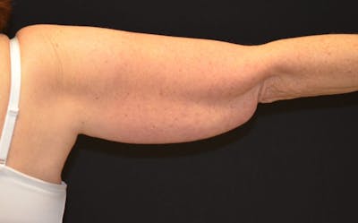 CoolSculpting Before & After Gallery - Patient 416257 - Image 1