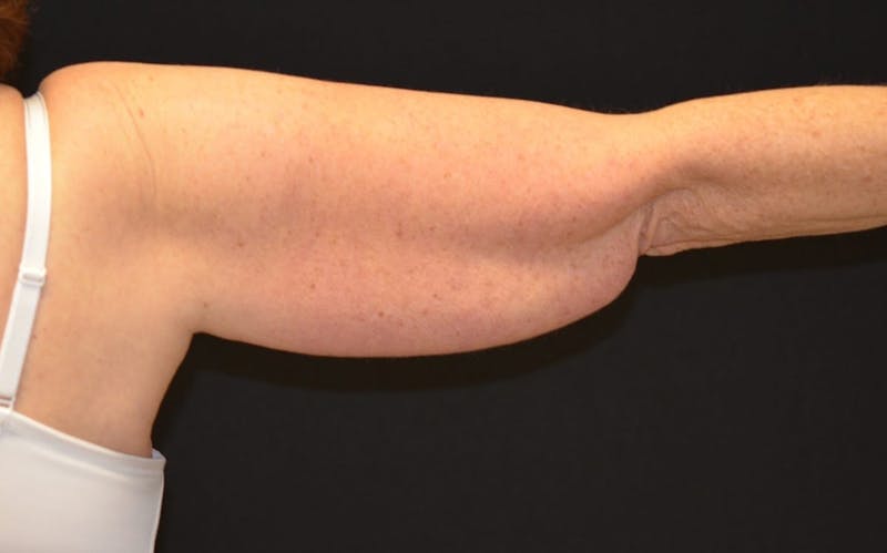 CoolSculpting Before & After Gallery - Patient 416257 - Image 1