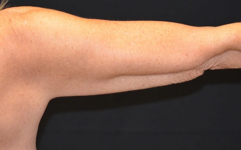 CoolSculpting Before & After Gallery - Patient 403947 - Image 2