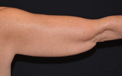 CoolSculpting Before & After Gallery - Patient 403947 - Image 1