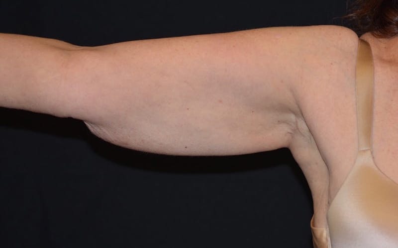 CoolSculpting Before & After Gallery - Patient 184859 - Image 2