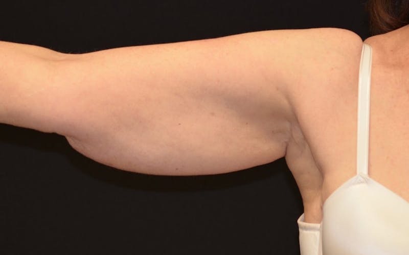 CoolSculpting Before & After Gallery - Patient 184859 - Image 1