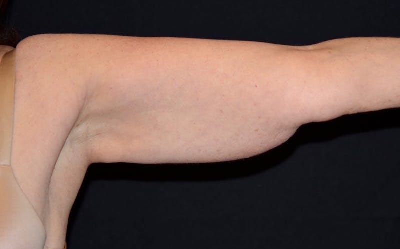 CoolSculpting Before & After Gallery - Patient 184859 - Image 4