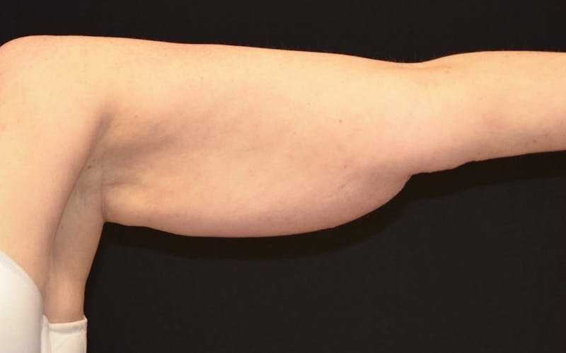 CoolSculpting Before & After Gallery - Patient 184859 - Image 3