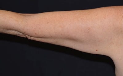CoolSculpting Before & After Gallery - Patient 227011 - Image 2