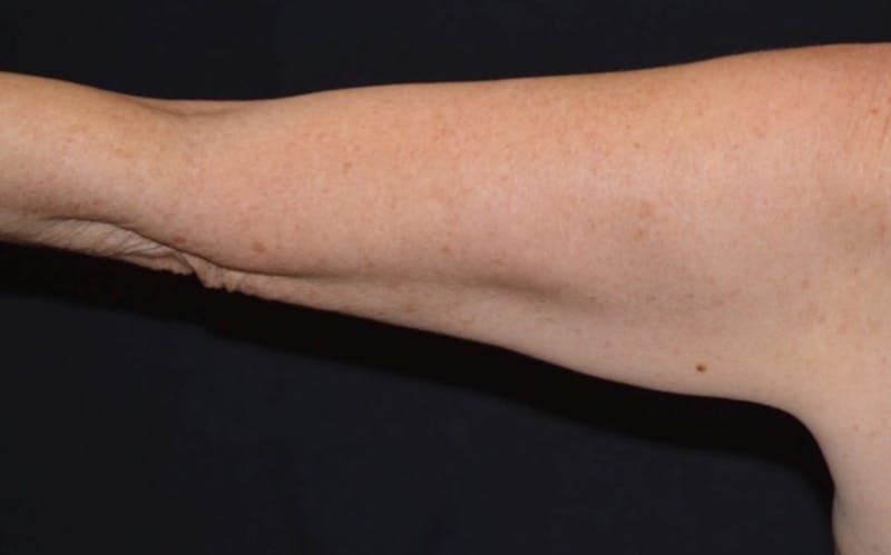 CoolSculpting Before & After Gallery - Patient 227011 - Image 2