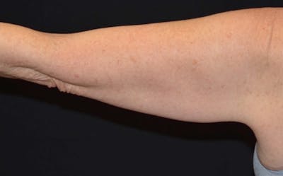 CoolSculpting Before & After Gallery - Patient 227011 - Image 1