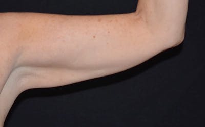 CoolSculpting Before & After Gallery - Patient 761471 - Image 2