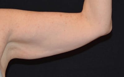 CoolSculpting Before & After Gallery - Patient 761471 - Image 1