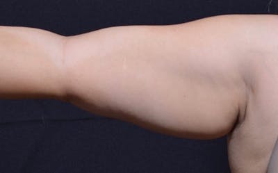 CoolSculpting Before & After Gallery - Patient 328183 - Image 1