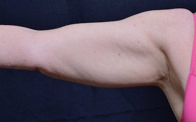 CoolSculpting Before & After Gallery - Patient 426161 - Image 2