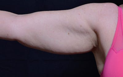 CoolSculpting Before & After Gallery - Patient 426161 - Image 1