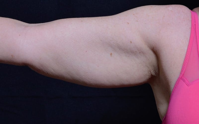 CoolSculpting Before & After Gallery - Patient 426161 - Image 1
