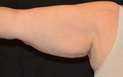 CoolSculpting Before & After Gallery - Patient 378922 - Image 2