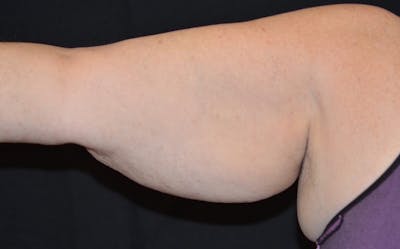 CoolSculpting Before & After Gallery - Patient 378922 - Image 1
