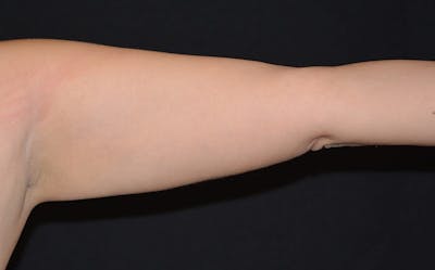 CoolSculpting Before & After Gallery - Patient 235070 - Image 2