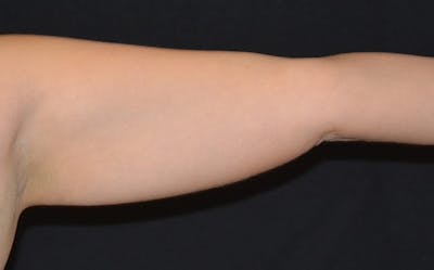 CoolSculpting Before & After Gallery - Patient 235070 - Image 1