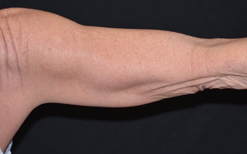 CoolSculpting Before & After Gallery - Patient 282041 - Image 2