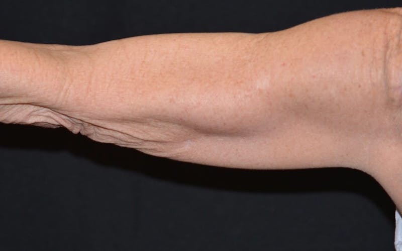 CoolSculpting Before & After Gallery - Patient 282041 - Image 4