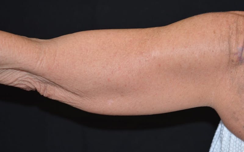 CoolSculpting Before & After Gallery - Patient 282041 - Image 3