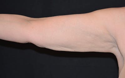 CoolSculpting Before & After Gallery - Patient 393413 - Image 2