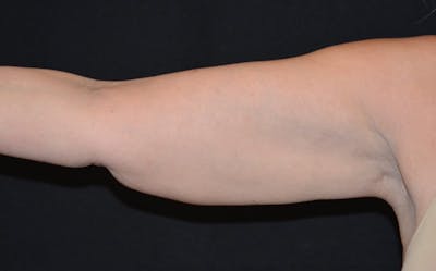 CoolSculpting Before & After Gallery - Patient 393413 - Image 1