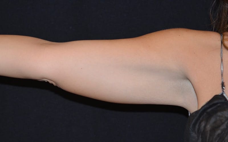 CoolSculpting Before & After Gallery - Patient 295743 - Image 2