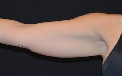 CoolSculpting Before & After Gallery - Patient 295743 - Image 1