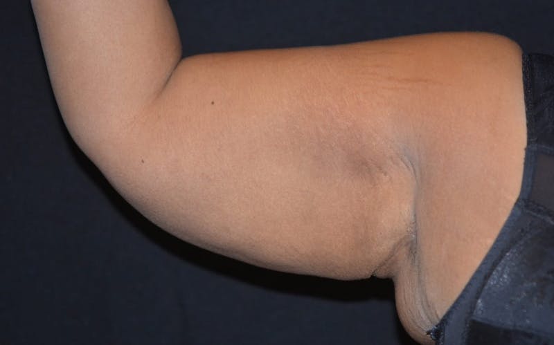 CoolSculpting Before & After Gallery - Patient 195483 - Image 2